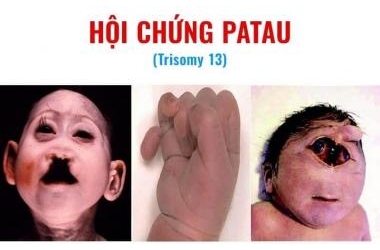 Hội chứng Patau (Trisomy 13): Nguyên nhân, triệu chứng và cách điều trị